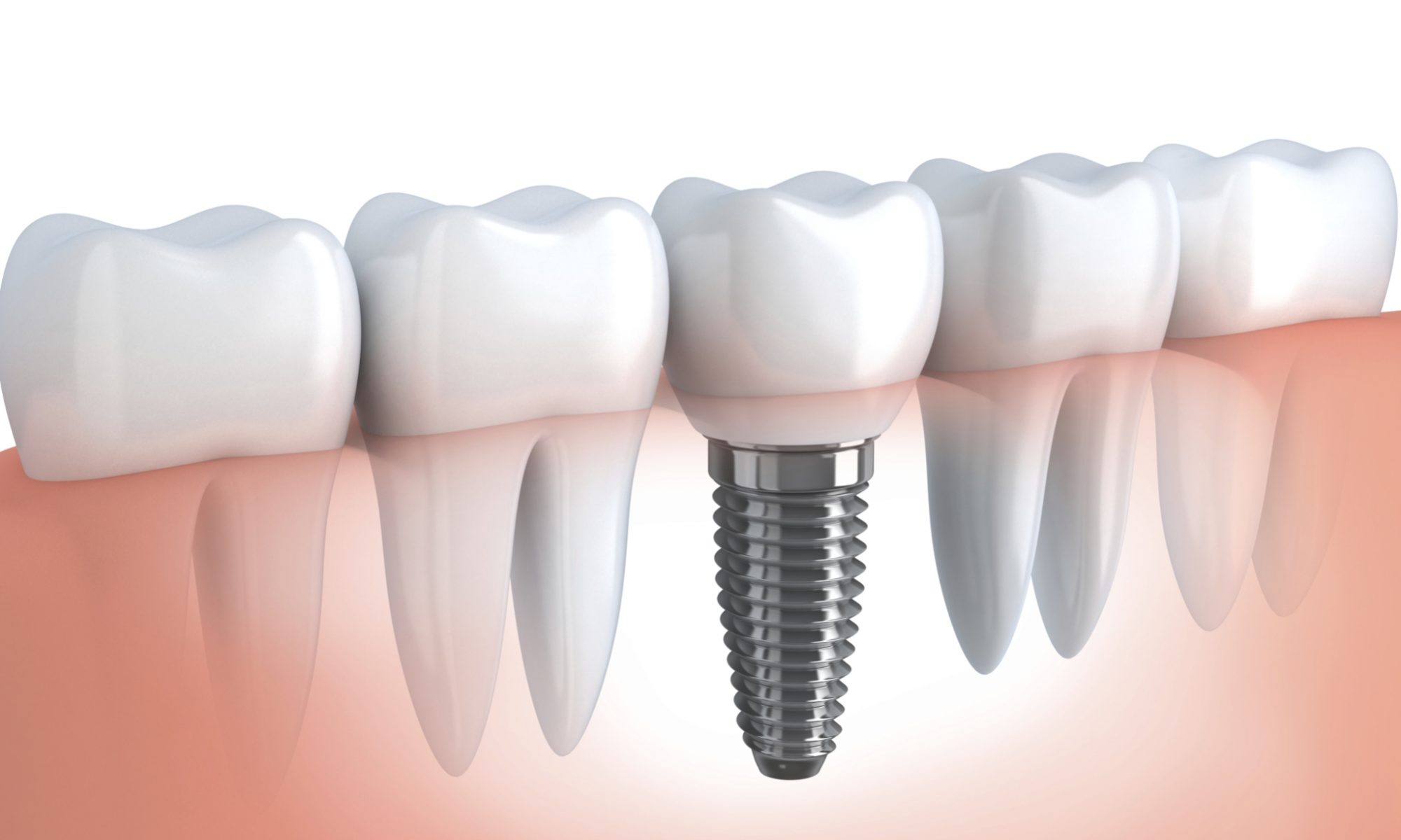 implant diagram