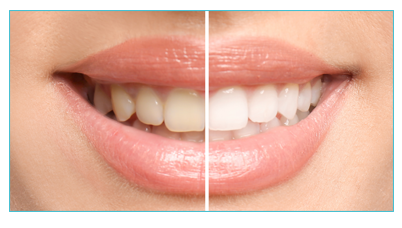 Teeth Whitening ottawa dentist