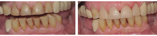 dental composite build up