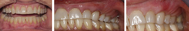 dental gum graft