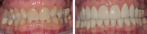 orthodontics and porcelain veneers