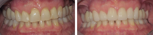 Restorations and Veneers