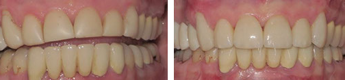 ottawa dentist veneers