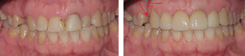 porcelain veneers
